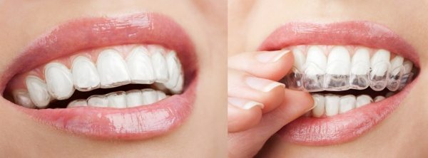 Sydney Braces - orthodontist How do invisible braces work?