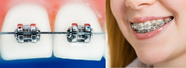 Ceramic Braces in Sydney