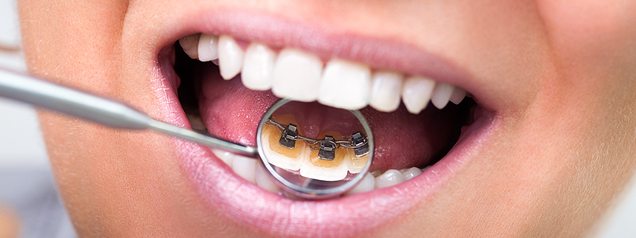 Discover the discreet alternative to get a straighter smile – lingual braces